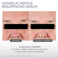 Mandelic Gentle Resurfacing Serum